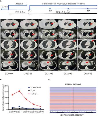 Case report: A lung squamous cell carcinoma patient with a rare EGFR G719X mutation and high PD-L1 expression showed a good response to anti-PD1 therapy